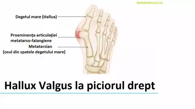 Valgus 2 in 1 la farmacia din Iași – tratament eficient pentru deformarea valgus a degetului mare la picior