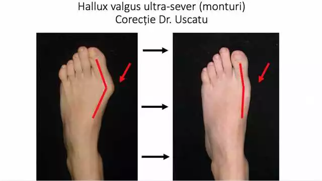Valgus 2 in 1 în Piatra Neamț: tratament eficient pentru degetele îndoite ale piciorului